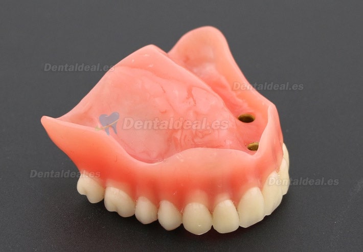 Dental Study Teeth Model Overdenture Superior With 4 Implants Demo Model 6001